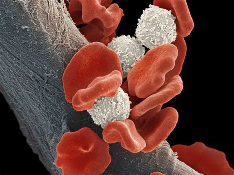Leukemia: Overview and More