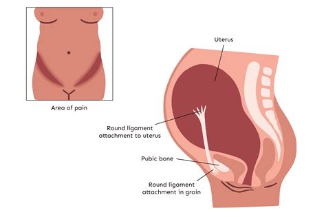 Round Ligament Pain in Pregnancy: How To Find Relief - Baby Chick