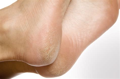 Schrunden richtig behandeln | Feetastic