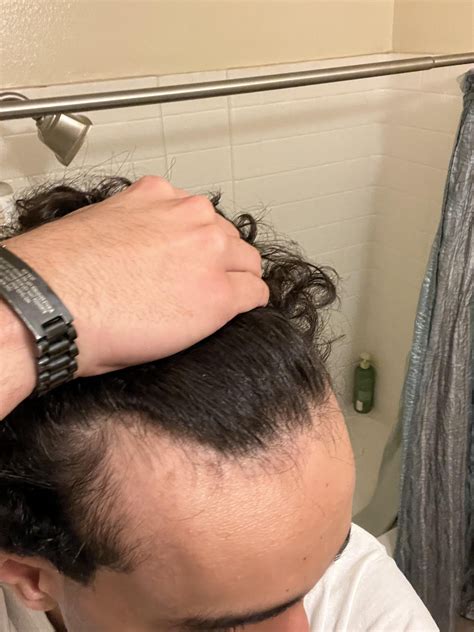 Diffuse thinning and receding hairline in highschool : r/Balding