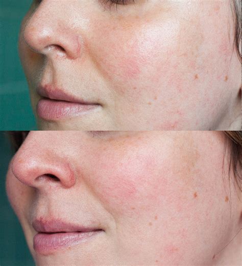 Beauty: does dermarolling work? - THE STYLING DUTCHMAN.