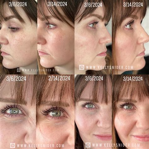 Unbelievable Blackhead Removal 2024: My Honest Review & Before/After Pics. Image 1