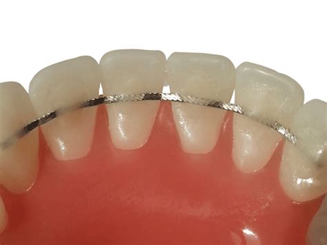 The Benefits of a Lingual Bonded Retainer