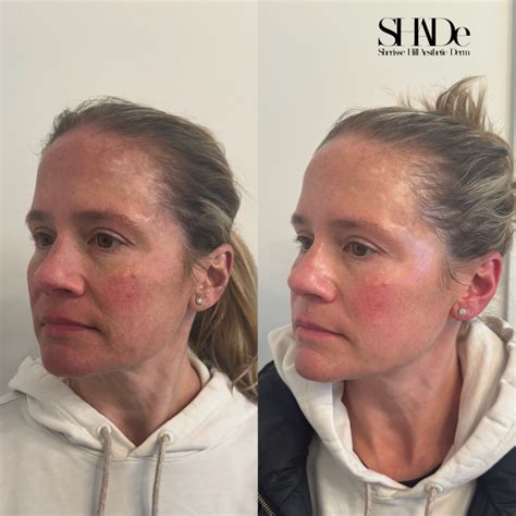 Before & After Photos for Microneedling in Issaquah, WA