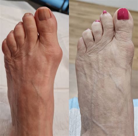 Hallux Valgus | Foot & Podiatry Surgery
