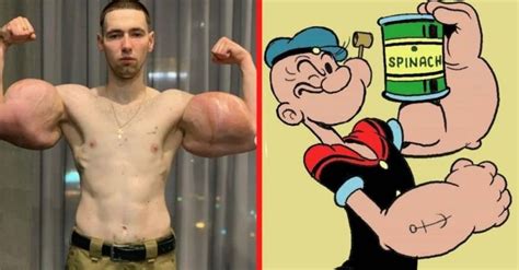 This Real-Life Popeye Has 3 Lbs Of Dead Muscle Removed From Biceps