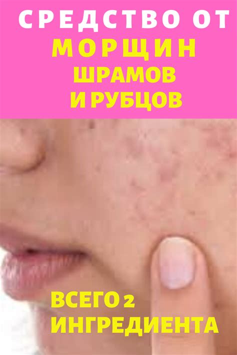 Средство от морщин шрамов и рубцов. Всего 2 ингредиента | Лучшие ...