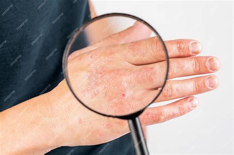 Использование смягчающего средства для сухой шелушащейся кожи, как при ...