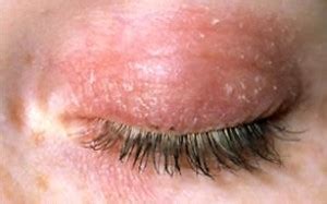 Eyelid Infection - Pictures, Causes, Treatment, Remedies