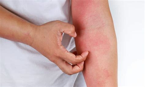 Alergia A Corante Vermelho - Alergia A Corante Sintomas - RETOEDU