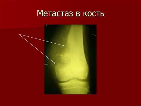 Метастазы в бедренной кости: виды, симптомы, лечение и прогноз