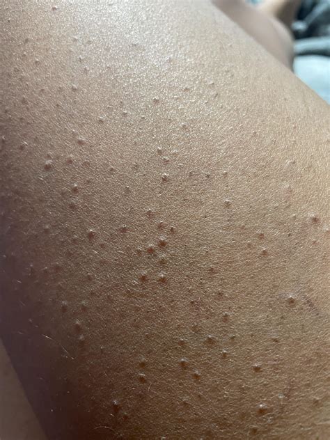 Is there any way to get rid of these bumps? : r/SkincareAddicts