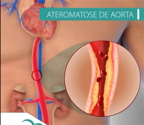 Ateromatose Da Aorta Abdominal E Grave - Ateromatose de Aorta - Dra. Bruna Henares