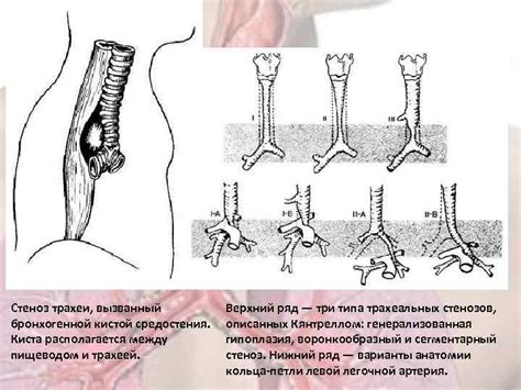 Вариантные и возрастные особенности развития трахеи и
