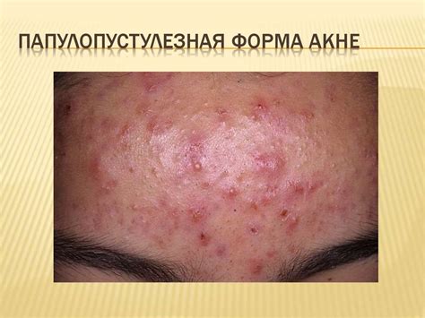 Вульгарные угри. Акне или угревая болезнь - презентация онлайн