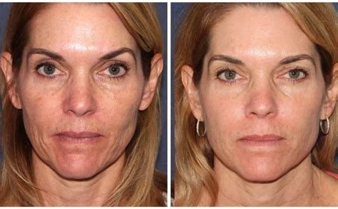 fraxel laser nyc dual fractional treatment  wrinkles scars sun