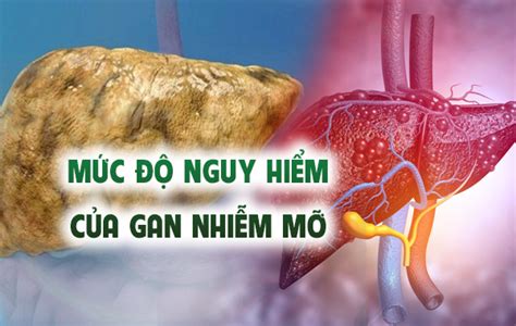 Bệnh Gan Nhiễm Mỡ Có Nguy Hiểm Không? Bệnh Gan Nhiễm Mỡ Nên Ăn Gì