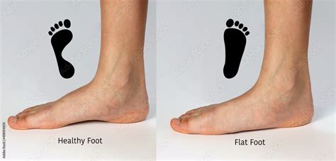 normal neutral healthy foot compare  flat foot  fallen arch