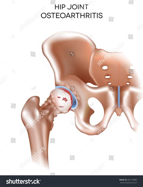 Arthritis Hip Joint Damaged Joint Cartilage Stock Illustration 281179985 - Shutterstock