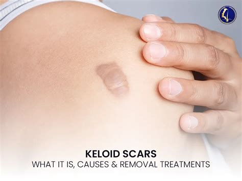 keloid scar    symptoms treatment removal