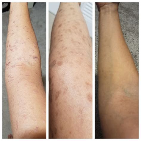 tiny bump   center   life