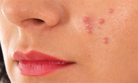 What causes face pimples? - Quora