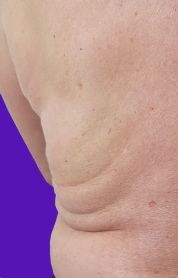 Non-Surgical Ultrasound Fat Removal | Anti Aging Center Of Boca