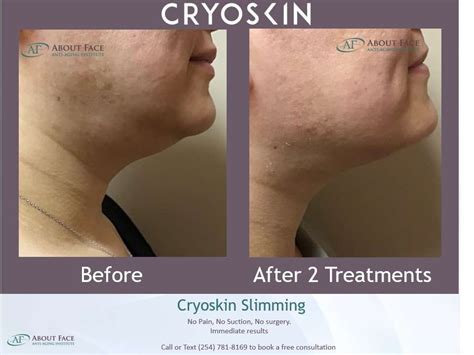 Cryoskin Facial: How It Works & What Are Its Benefits