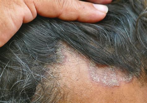 itchy red spots  scalp