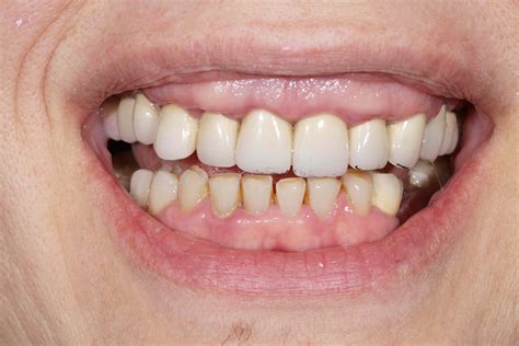 What Are Prosthetic Teeth Made Of at Ronald Caster blog
