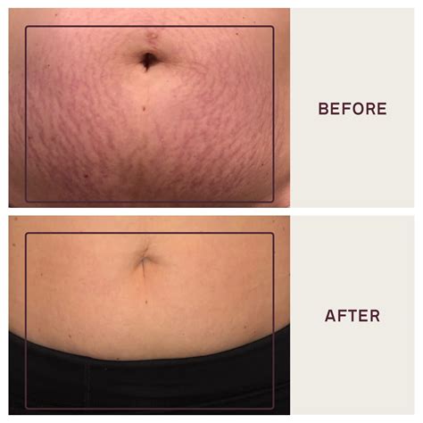 Dermaclara Silicone Stretch Marks Patch Kit | Scar Treatment Gel