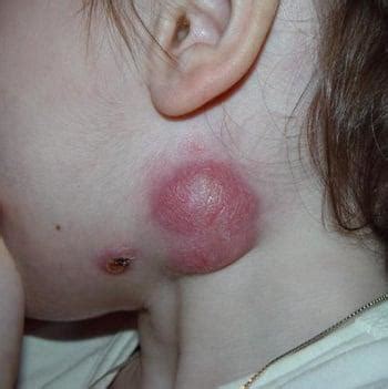 Lymphadenitis - Skin Disorders - MSD Manual Consumer Version