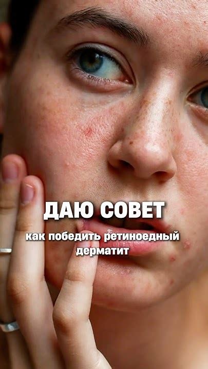 Как убрать ретиноевый дерматит? #косметолог #уходзакожей #косметика # ...