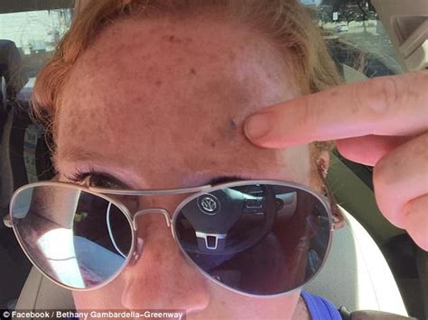 Melanoma leaves women with huge open wound on her forehead