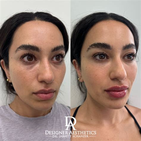 undereye filler designer aesthetics  dr jarrett schanzer miami