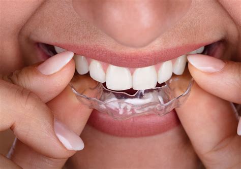 clear aligners  south side richmond va  smiles south side