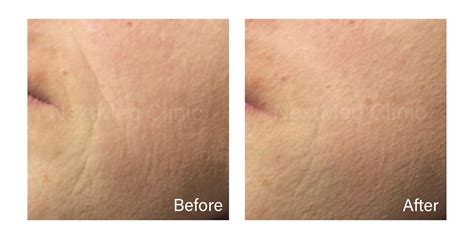 Best Plinest Treatment in Malaysia - NextMed Clinic