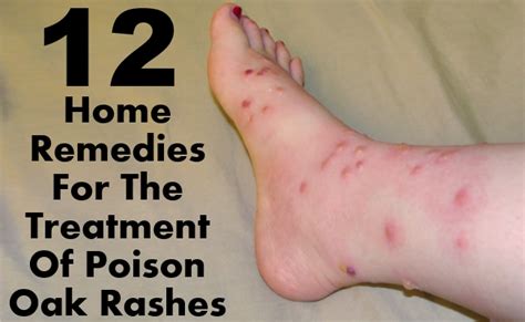 12 Effective Home Remedies For The Treatment Of Poison Oak Rashes | Morpheme Remedies | India