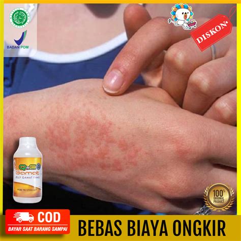 Obat Alergi Matahari - Obat Penyakit Kulit - Obat Ruam Kulit - Kulit ...