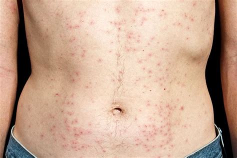9 Common Bacterial Skin Infections