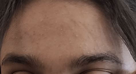how to treat forehead acne and acne scars : r/acne