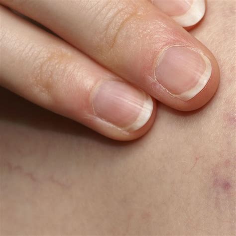 Porphyria