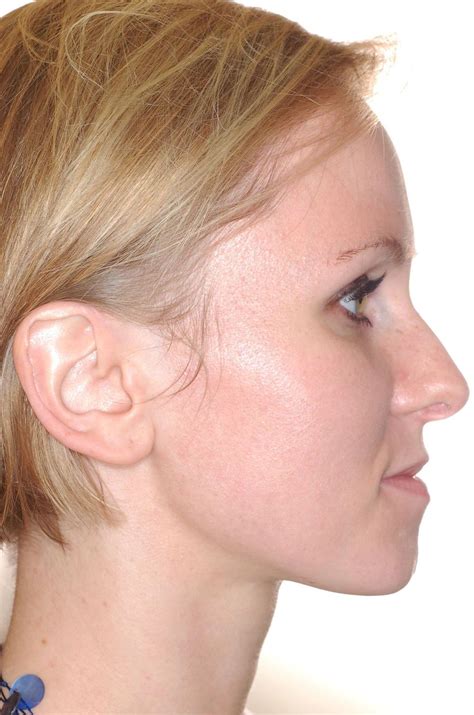 lateral view  treatment  side  scientific diagram