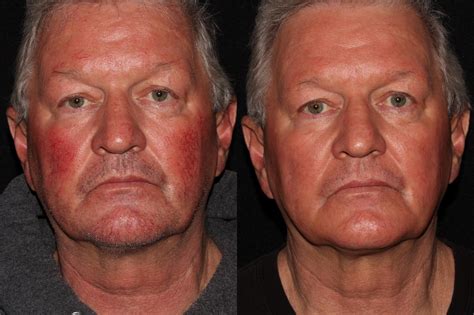 BBL™ PhotoFacial Before and After Pictures Case 9 | Chico, Yuba City ...