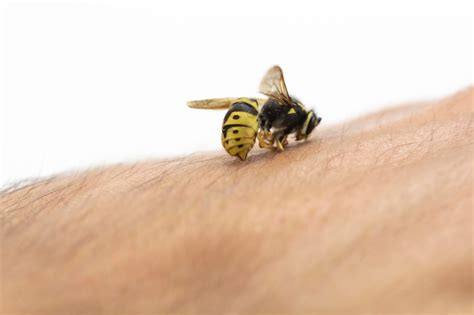 Premium Photo | Bee stinging in human hand