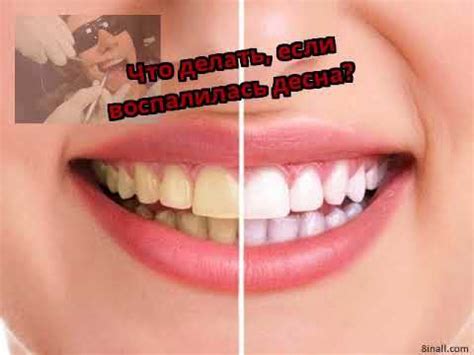 Что делать, если воспалилась десна? - YouTube