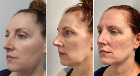 Ozempic Face: Before And After Considerations