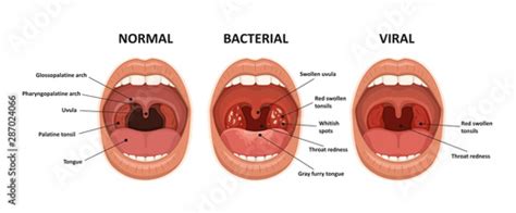 Tonsillitis bacterial and viral. Angina, pharyngitis and tonsillitis ...