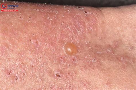 benh bong nuoc dang pemphigus trieu chung va cach dieu tri