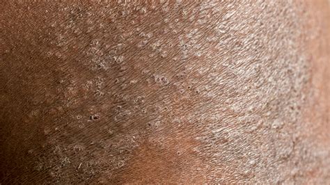 eczema  people  color gladskin